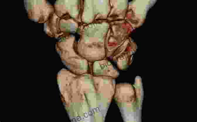 3D Ultrasound Reconstruction Of The Wrist Ultrasonography Of The Upper Extremity: Hand And Wrist