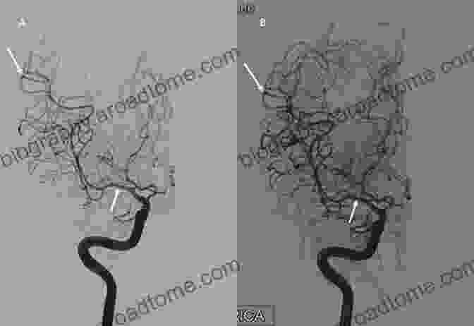 Angiogram Of Cerebral Vasospasm Early Brain Injury Or Cerebral Vasospasm: Vol 1: Pathophysiology (Acta Neurochirurgica Supplement 110)