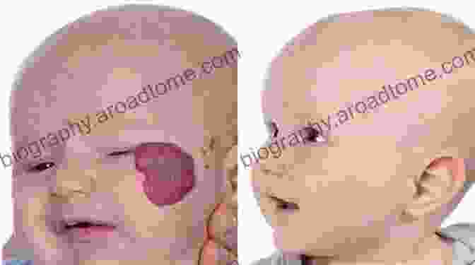 Close Up Of A Patient With A Hemangioma On Their Face Hemangiomas And Vascular Malformations: An Atlas Of Diagnosis And Treatment