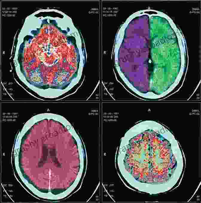 Computed Tomography (CT) Of The Brain In Dementia Neuroimaging In Dementia