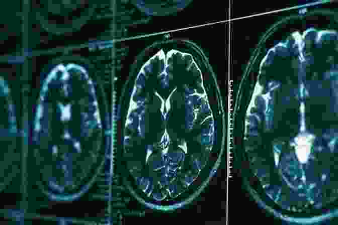 CT Scan Of Early Brain Injury Early Brain Injury Or Cerebral Vasospasm: Vol 1: Pathophysiology (Acta Neurochirurgica Supplement 110)