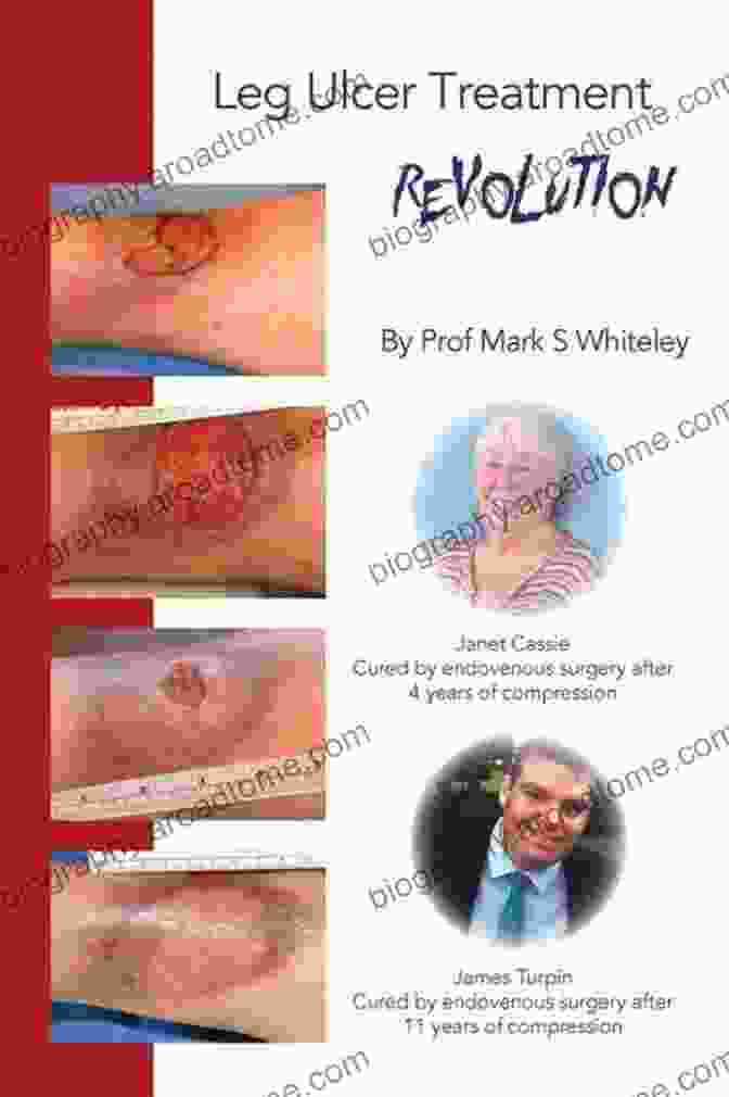 Leg Ulcer Treatment Revolution Book Cover By Mark Whiteley Featuring A Depiction Of A Healed Leg Ulcer And The Author's Signature. Leg Ulcer Treatment Revolution Mark S Whiteley