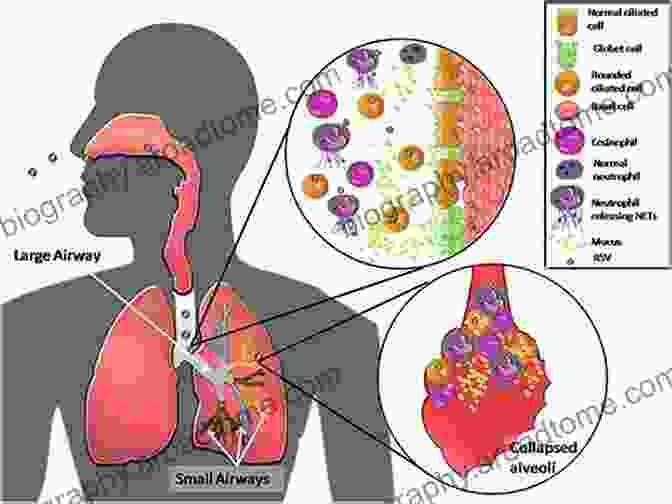 Microscopic Image Showing A Virus Infecting Lung Cells Viral Pathogenesis: From Basics To Systems Biology