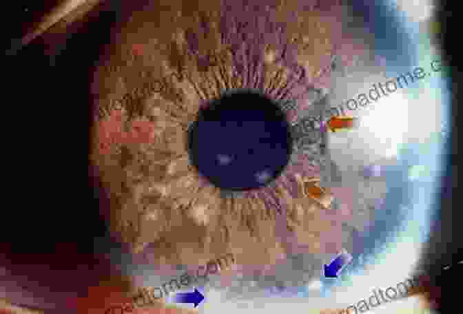 Microscopic View Of Ocular Disease Progression, Highlighting The Cellular And Molecular Changes That Disrupt Eye Health. Basic Sciences For Ophthalmology (Oxford Specialty Training: Basic Science)