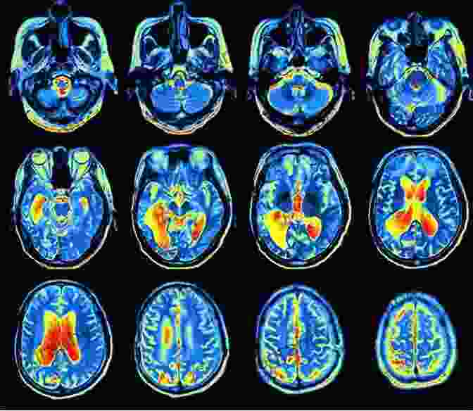 Positron Emission Tomography (PET) Of The Brain In Dementia Neuroimaging In Dementia