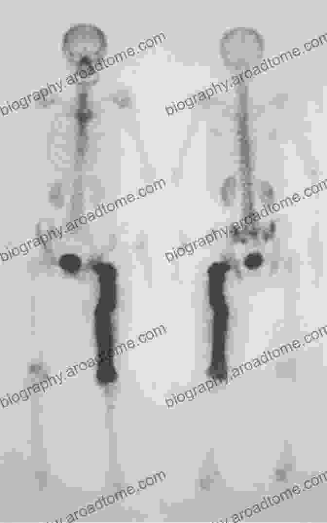 Radionuclide Imaging: Unveiling The Hidden Radionuclide Imaging Of Infection And Inflammation: A Pictorial Case Based Atlas