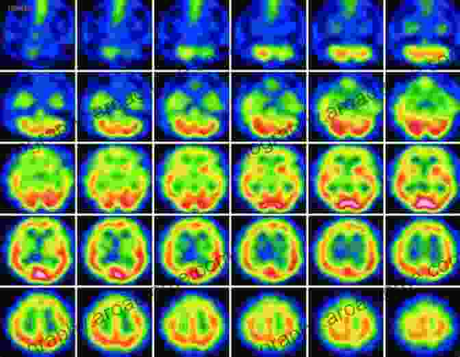 Single Photon Emission Computed Tomography (SPECT) Of The Brain In Dementia Neuroimaging In Dementia