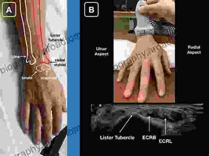 Ultrasound Anatomy Of The Hand And Wrist Ultrasonography Of The Upper Extremity: Hand And Wrist