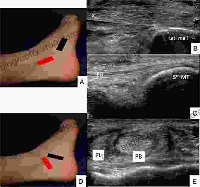 Ultrasound Image Of A Tendon Injury Ultrasonography Of The Upper Extremity: Hand And Wrist