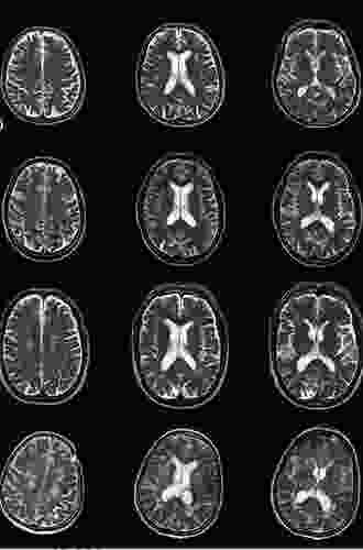 Neuroimaging In Dementia