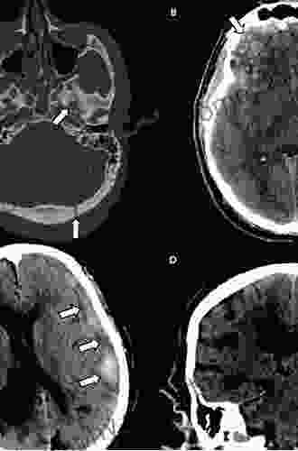 Neuroimaging Of Traumatic Brain Injury