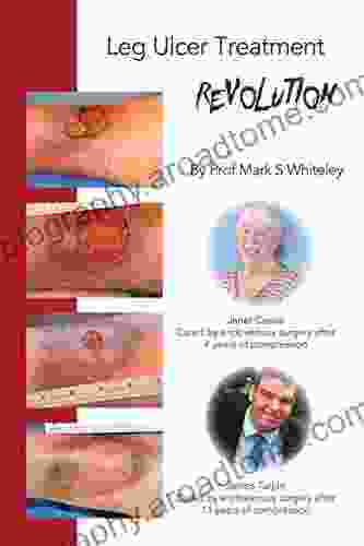 Leg Ulcer Treatment Revolution Mark S Whiteley