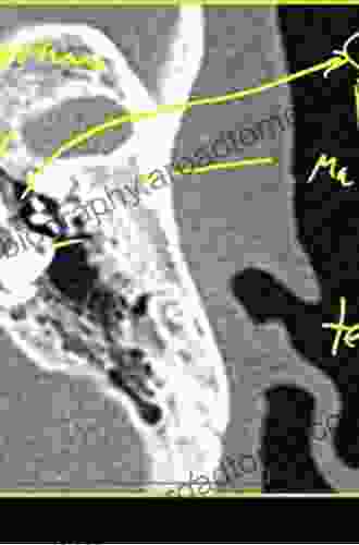 Temporal Bone CT And MRI Anatomy: A Guide To 3D Volumetric Acquisitions